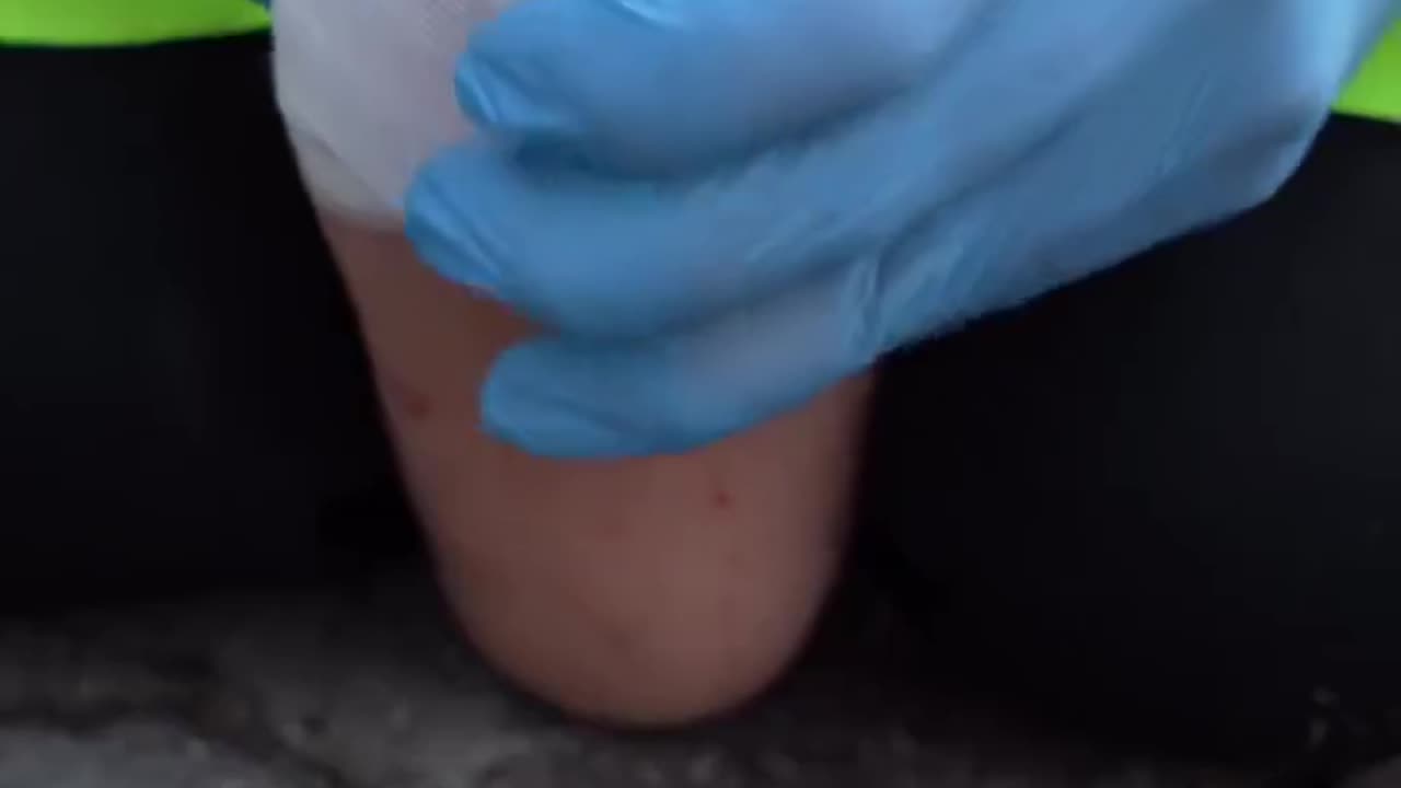 First aid in case you step on a nail!