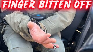 BRUTAL: Minnesota Rioter BITES Off HSI Officer’s Finger | ICE Protest Turns Violent