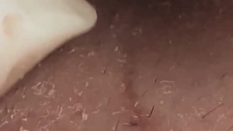 Blackheads Removal | Acne Treatment and Very Satisfying Satisfying Pimple pop (ASMR) #5 #blackheads