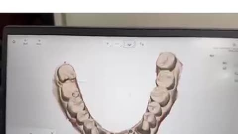 Restore Your Smile with the Best Dental Implant in Mohali