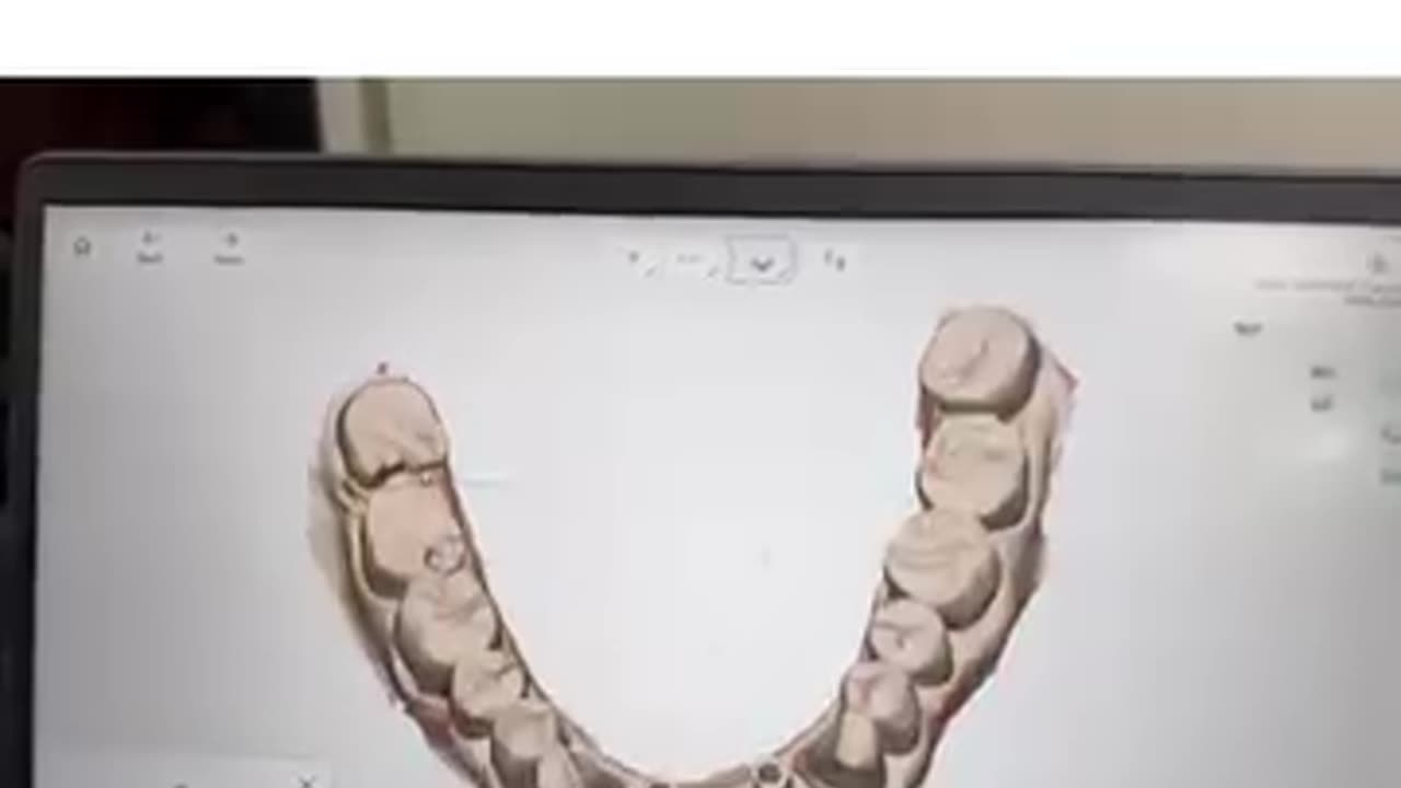 Restore Your Smile with the Best Dental Implant in Mohali
