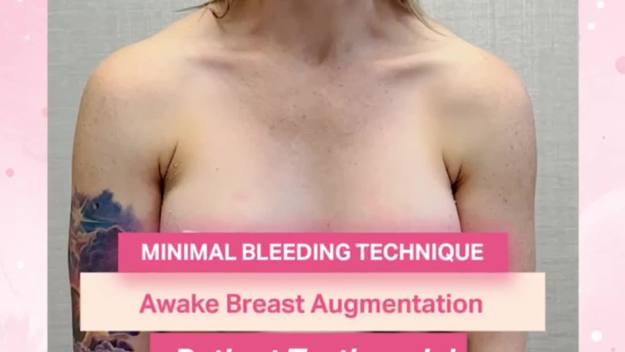 Awake Breast Augmentation with Minimal Bleeding | Dr. Kenneth Kim’s Patient Shares Her Experience