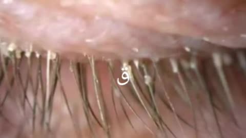 Mites and eyelashes