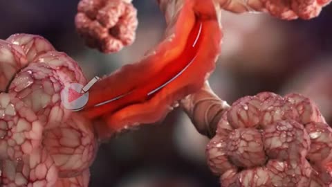 What Happens During Asthma (3D Animation)