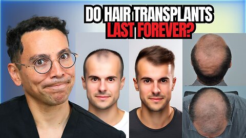 Are hair transplants truly permanent? 🧑‍⚕️