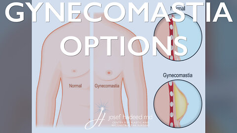 Gynecomastia Option | Gynecomastia Repair | Male Chest Surgery