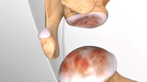 Can’t Lift Your Arm Here’s How Shoulder Replacement Surgery Restores Full Motion