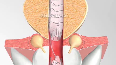 Urethral Stent Placement (3D Animation)