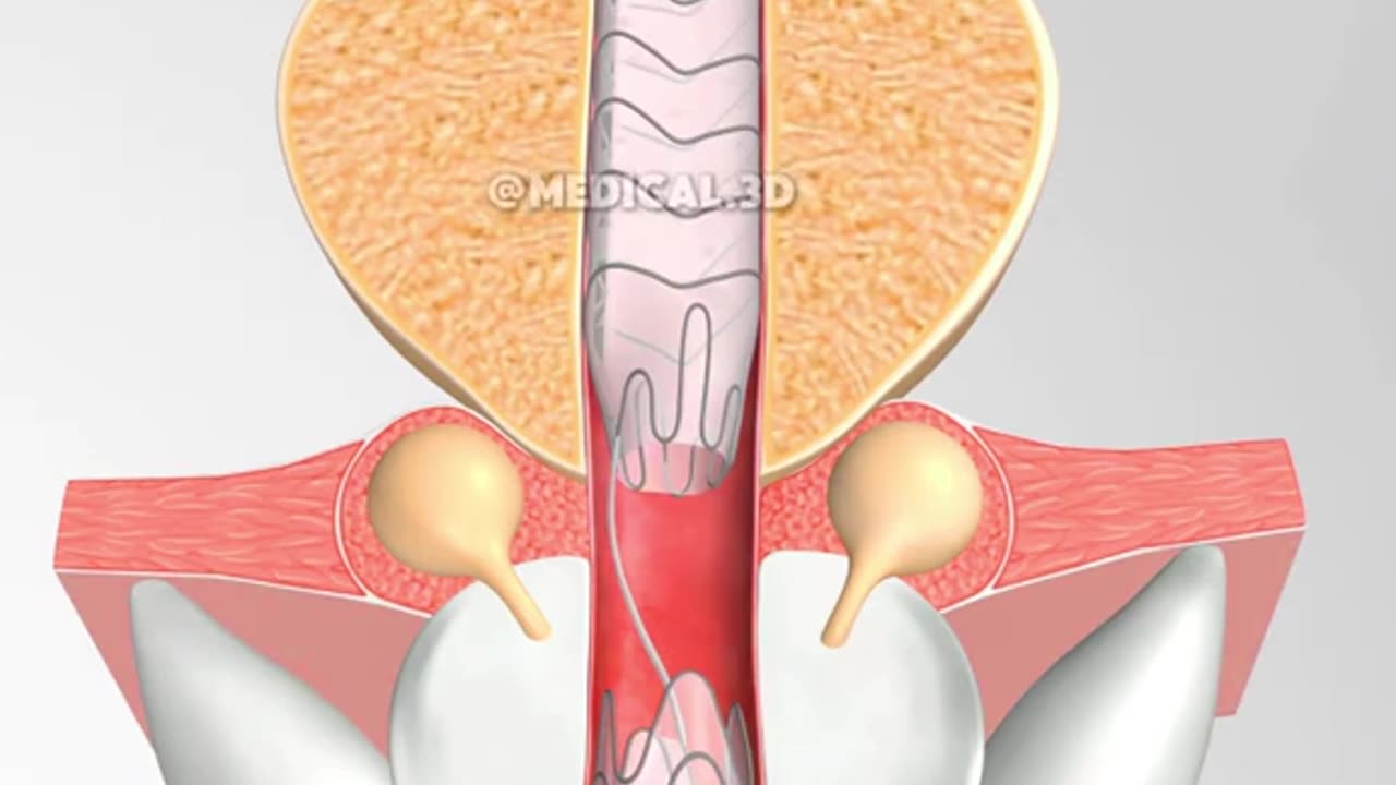 Urethral Stent Placement (3D Animation)
