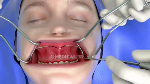 Bimaxillary osteotomy Surgery (3D Animation)