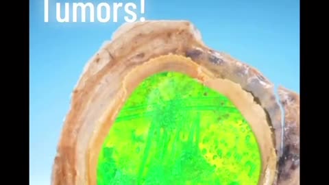 HERE IS WHY YOU NEVER BIOPSY A TUMOR