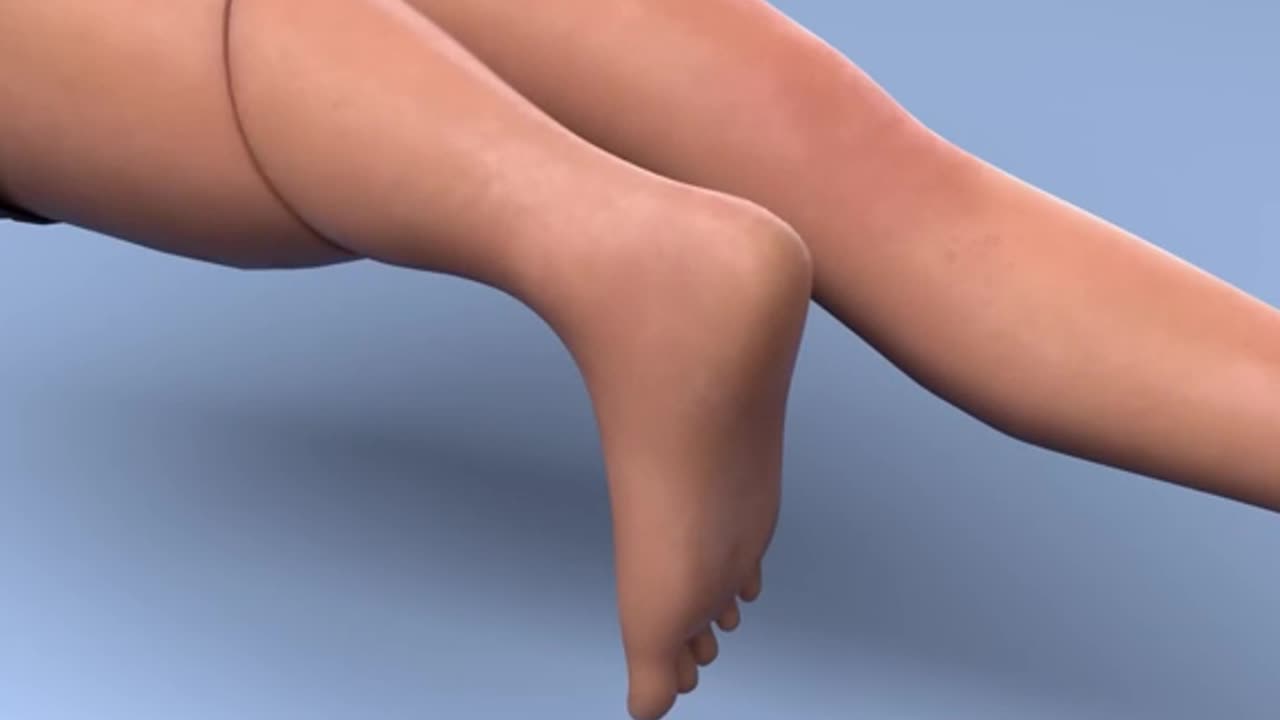 Rotationplasty Procedure 3D Animation