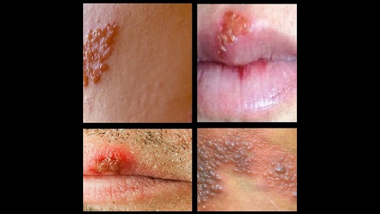 I WAS CURED OF HERPES SIMPLEX VIRUS BY DR WATER, Whatsapp +2349050205019