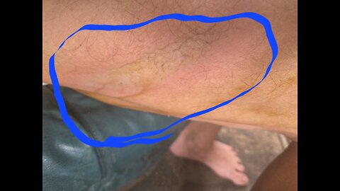 [1ST & 2ND DEGREE BURNS, PAIN NEAR GONE]