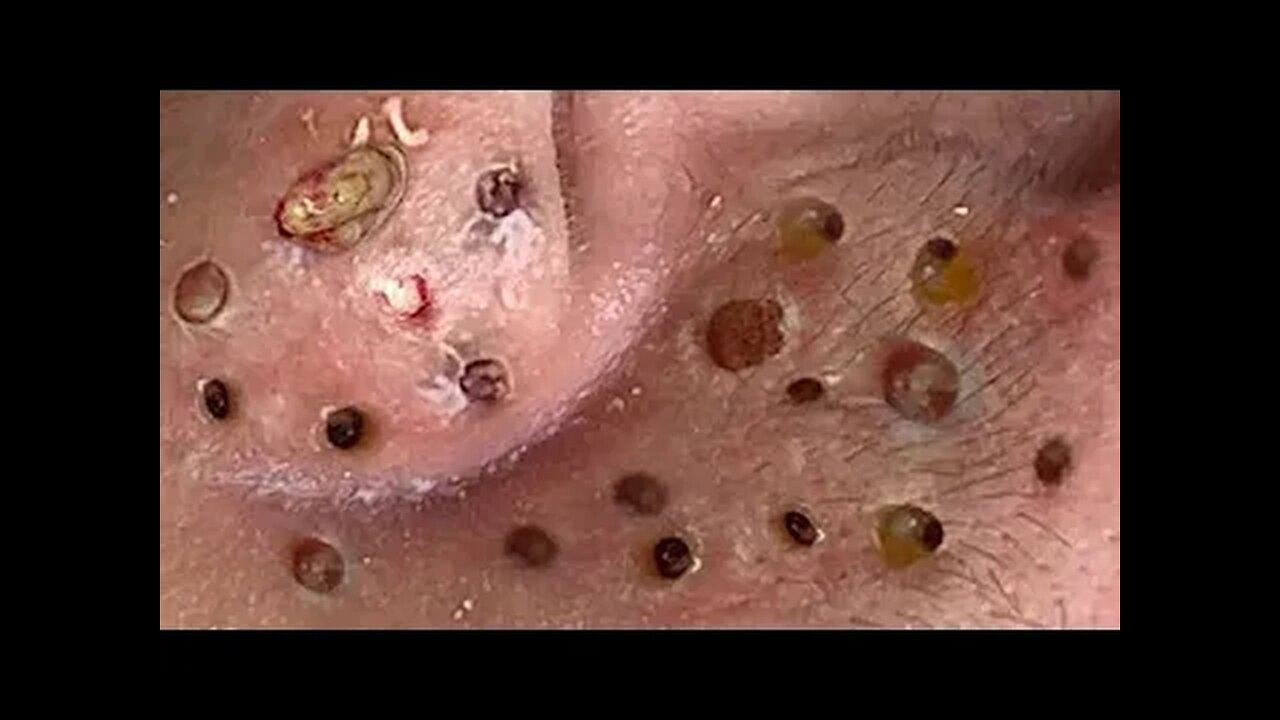 Blackheads Removal & Pimple Popper Cystic Acne Extraction #220