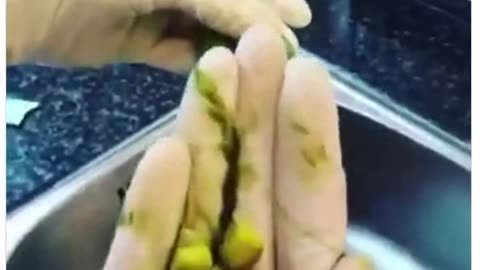 Dissection of a Gallbladder to Reveal Gallstones