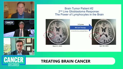 Breaking New Ground in Glioblastoma Treatment