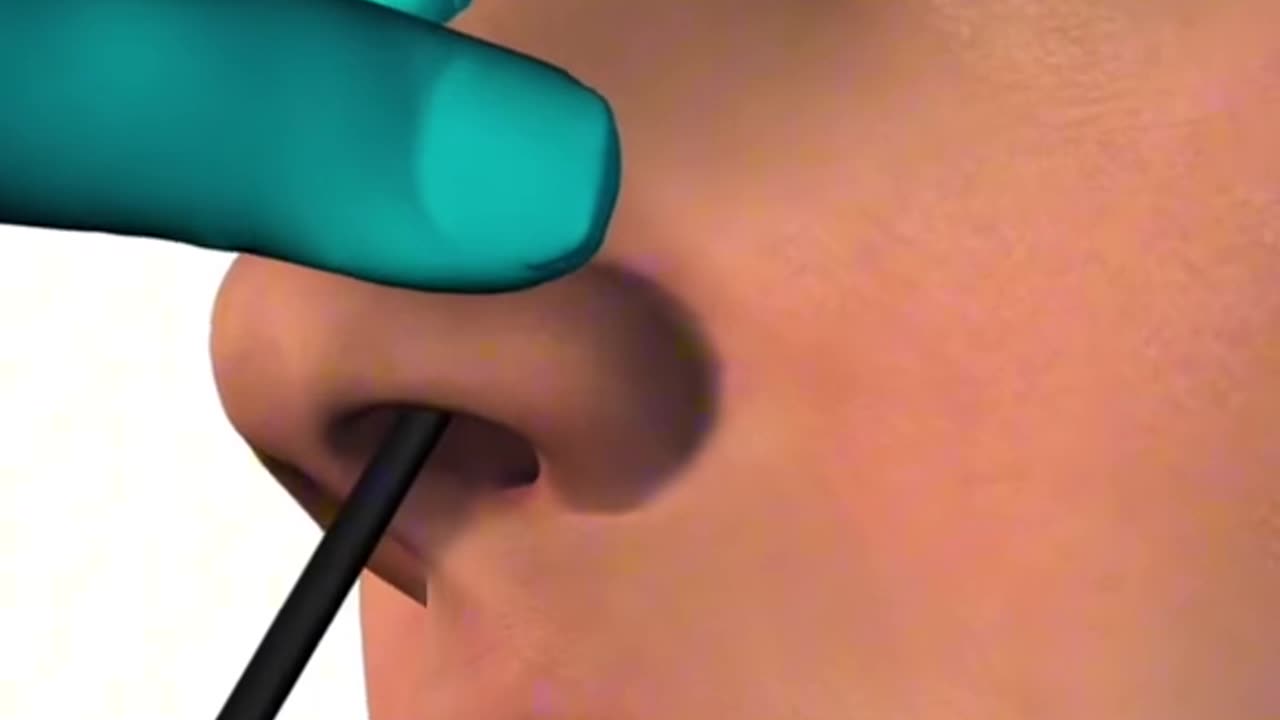 Nasal Septal Procedure 3D Animation