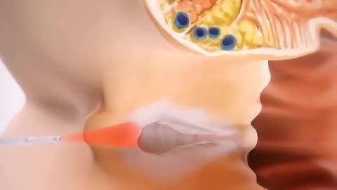 Anal Fissure Laser Surgery Treatment #viral