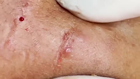 Blackheads Removal & Pimple Popper Cystic Acne Extraction #220