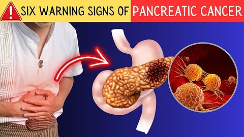 Catch These Six Subtle Signals of Pancreatic Cancer Before It’s Too Late! MD02