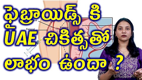 ఫైబ్రాయిడ్స్ UAE చికిత్సతో లాభం ఉందా?Benifits of Uterine Artery Blocking or Embolization of Fibroids