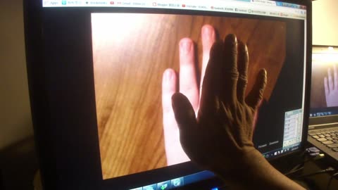 Luodong Gives Online Treatment To Injured Hand