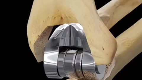 Elbow Joint Transplant Surgery Procedure & Recovery Explained