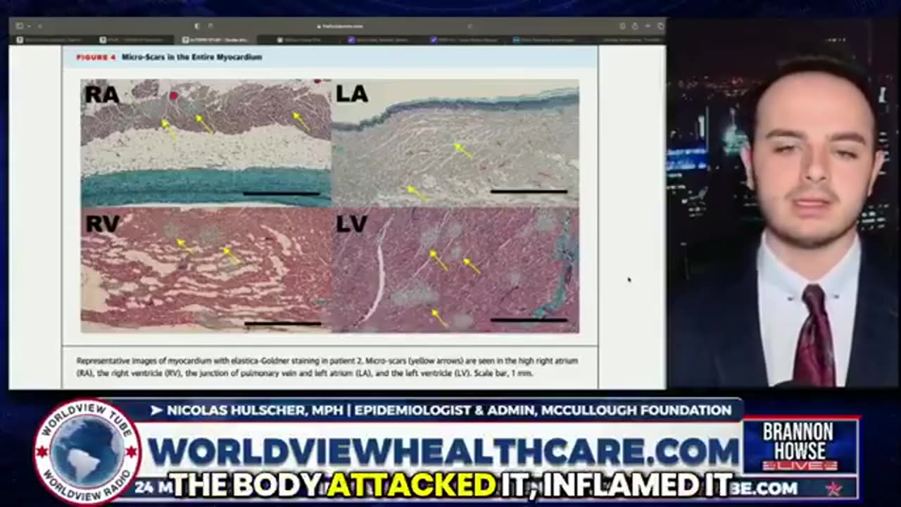 What the human heart looks like after five ‘Covid mRNA Booster Shots...scarred