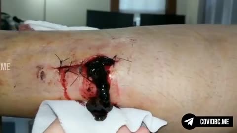 Ein vollständig mRNA geimpfter Mann kommt von einer Operation nach Hause - Blutgerinsel "Anschauen"!