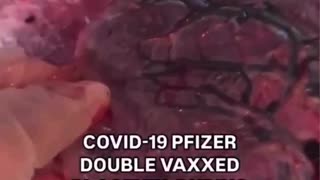 What The Vax Did To A Womans Placenta 😱