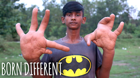 The Teen With The Giant Hands | BORN DIFFERENT