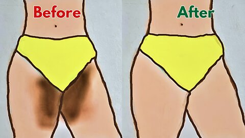How to lighten Dark Inner Thighs FAST and NATURALLY | Dark inner thighs: causes and treatments