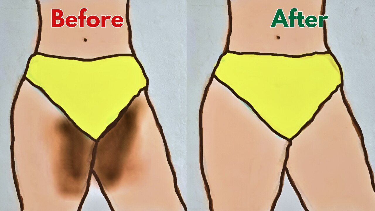 How to lighten Dark Inner Thighs FAST and NATURALLY | Dark inner thighs: causes and treatments