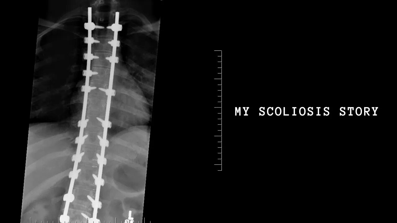 My Scoliosis Story || 4 Rods & 36 Screws