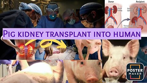 #Pig kidney transplanted into human body