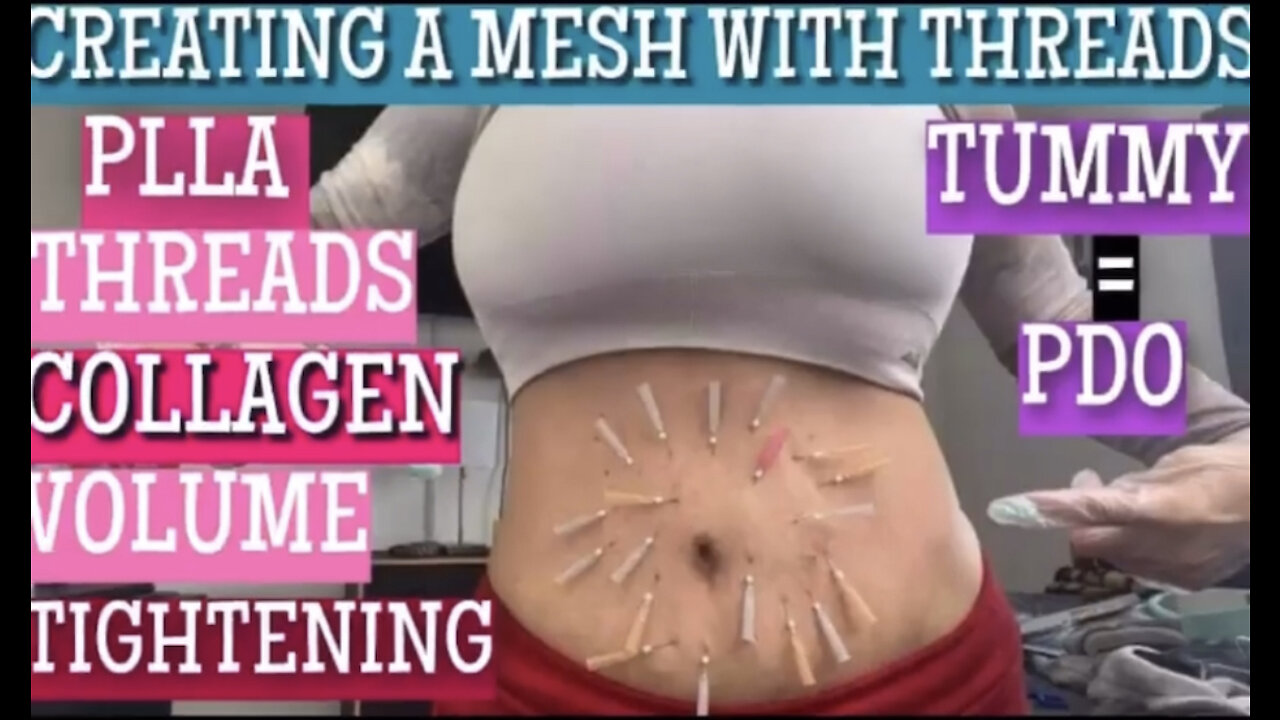 Tummy Tightening Using PLLA