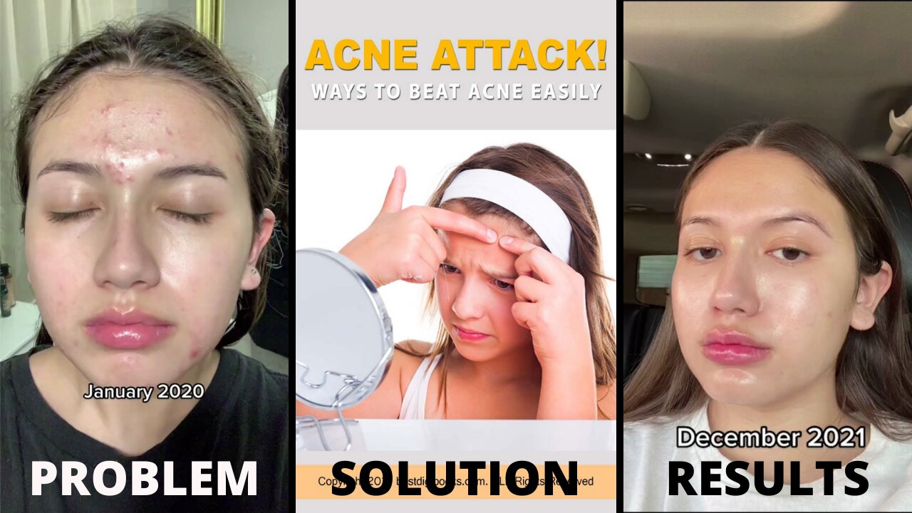 Acne Removal