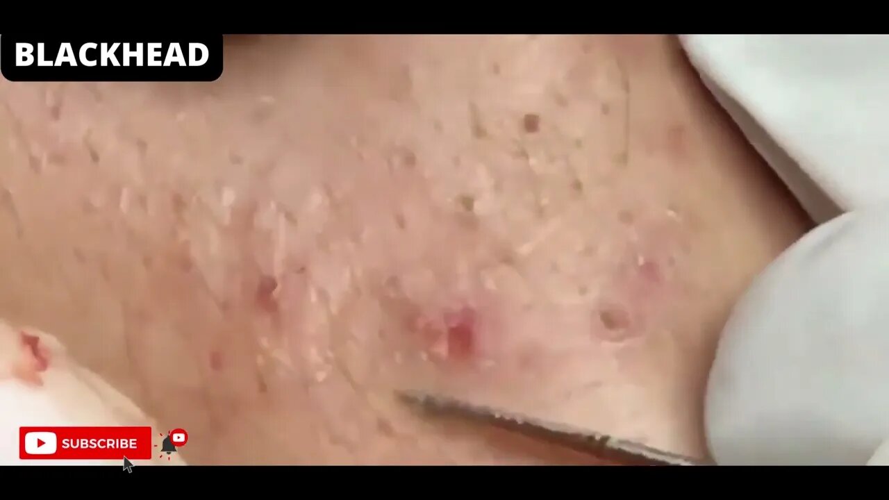 Removal / extraction of blackheads and pimples. Satisfying videos to relax!