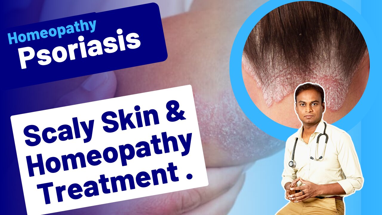 Psoriasis and Homeopathy Treatment . |Dr. Bharadwaz | Medicine & Surgery Homeopathy