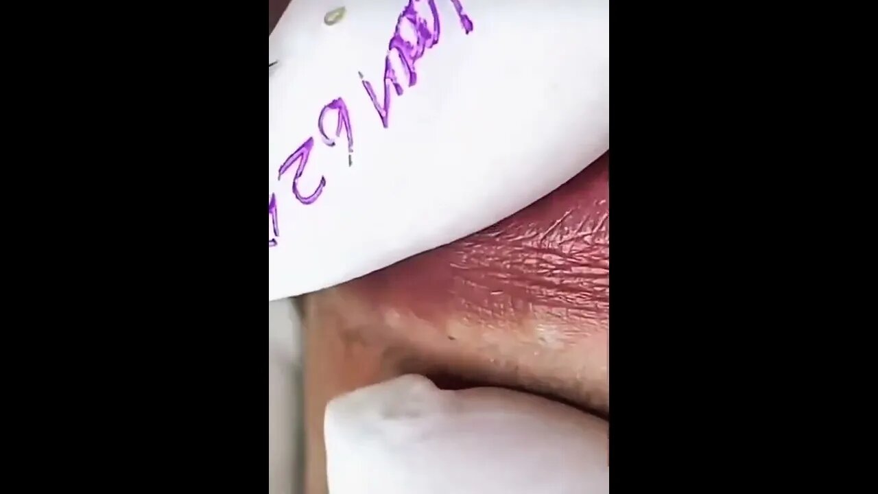 Zoomed Lips Blackheads Removal 💋