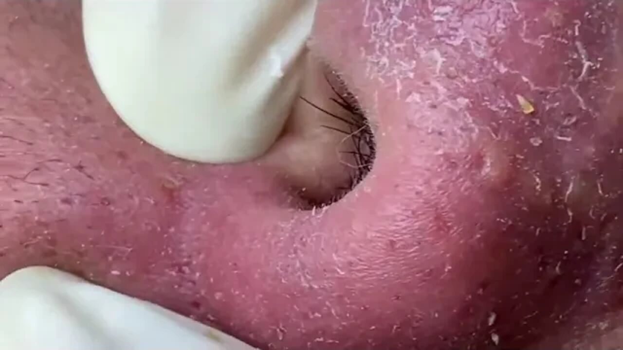 Removal / extraction of blackheads in the nose! Satisfying videos to relax!