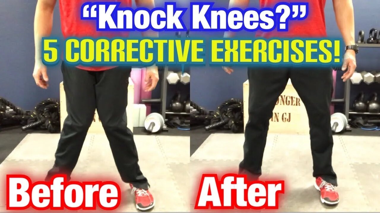 "Knock Knees" *Genu Valgum* 5 BEST CORRECTIVE EXERCISES! | Dr Wil & Dr K