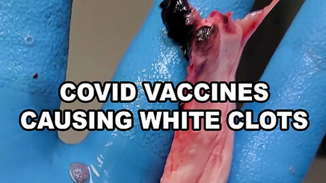 Bombshell Whistleblower Embalmer White Blood Clots in the Body of Living vaxxed