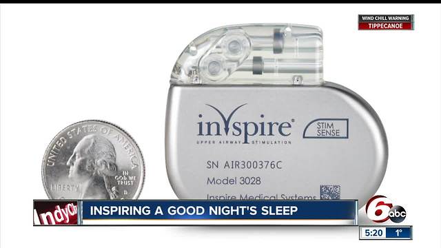 Central Indiana doctor one of the first in U.S. to install new Inspire sleep apnea devices