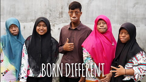 The Family Whose Faces Change Shape | BORN DIFFERENT