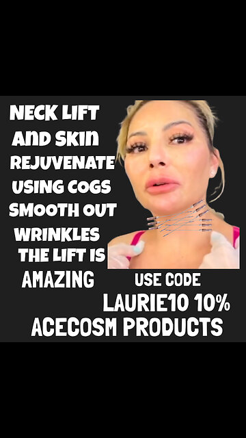 Neck Tightening and Lift With PDO Cogs N-25