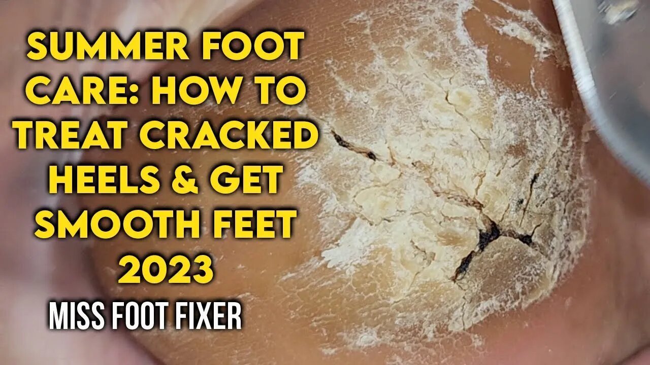 Summer Foot Care: How to Treat Cracked Heels and Get Smooth Feet by foot Specialist Miss foot Fixer