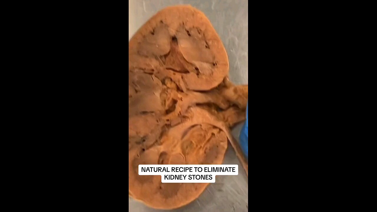 the natural receipt to eliminate kidney stones from your body
