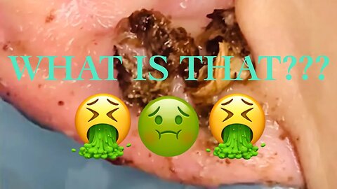 EARWAX REMOVAL 2023